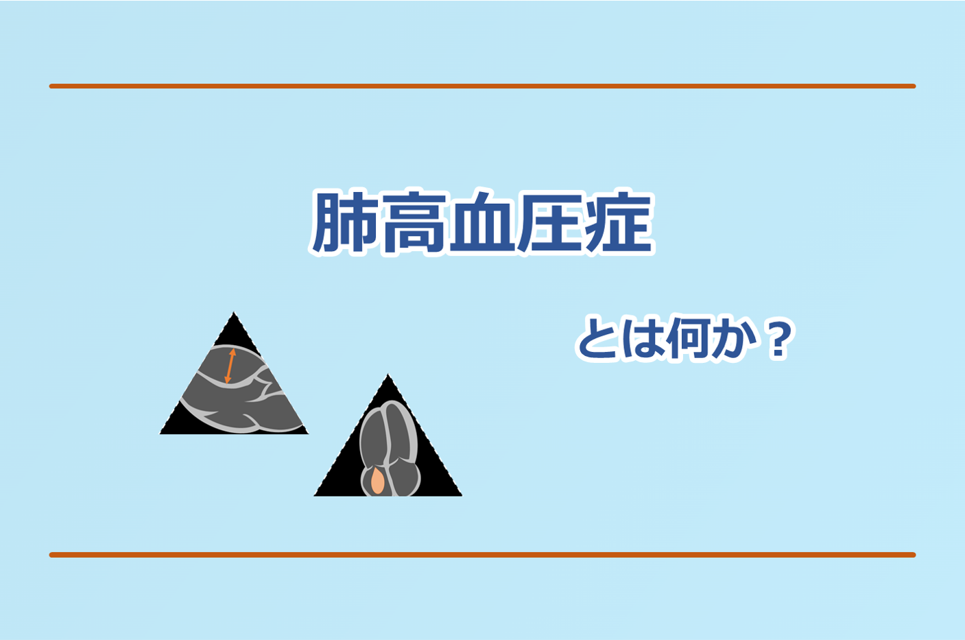 肺高血圧症について循環器専門医が解説します