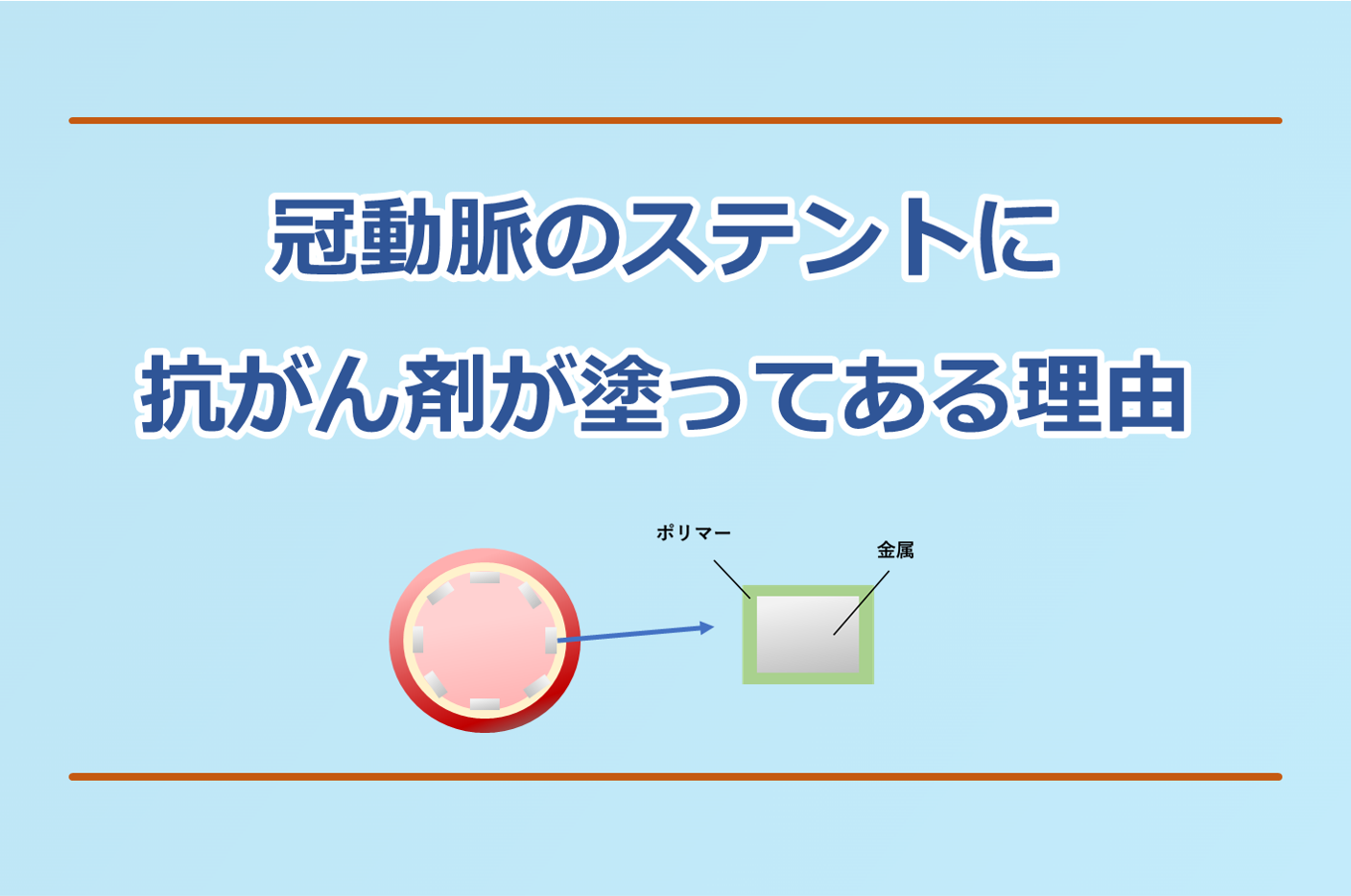 心臓カテーテル治療の薬剤溶出ステントについて解説