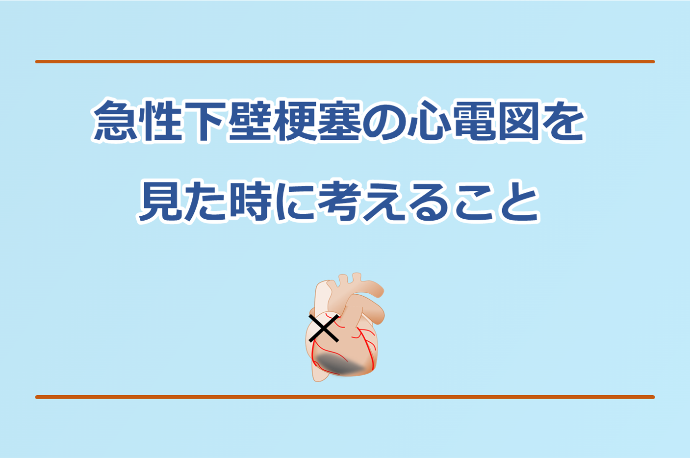 急性下壁梗塞の心電図を見た時に考えることを解説。右室梗塞、房室ブロックに注意。