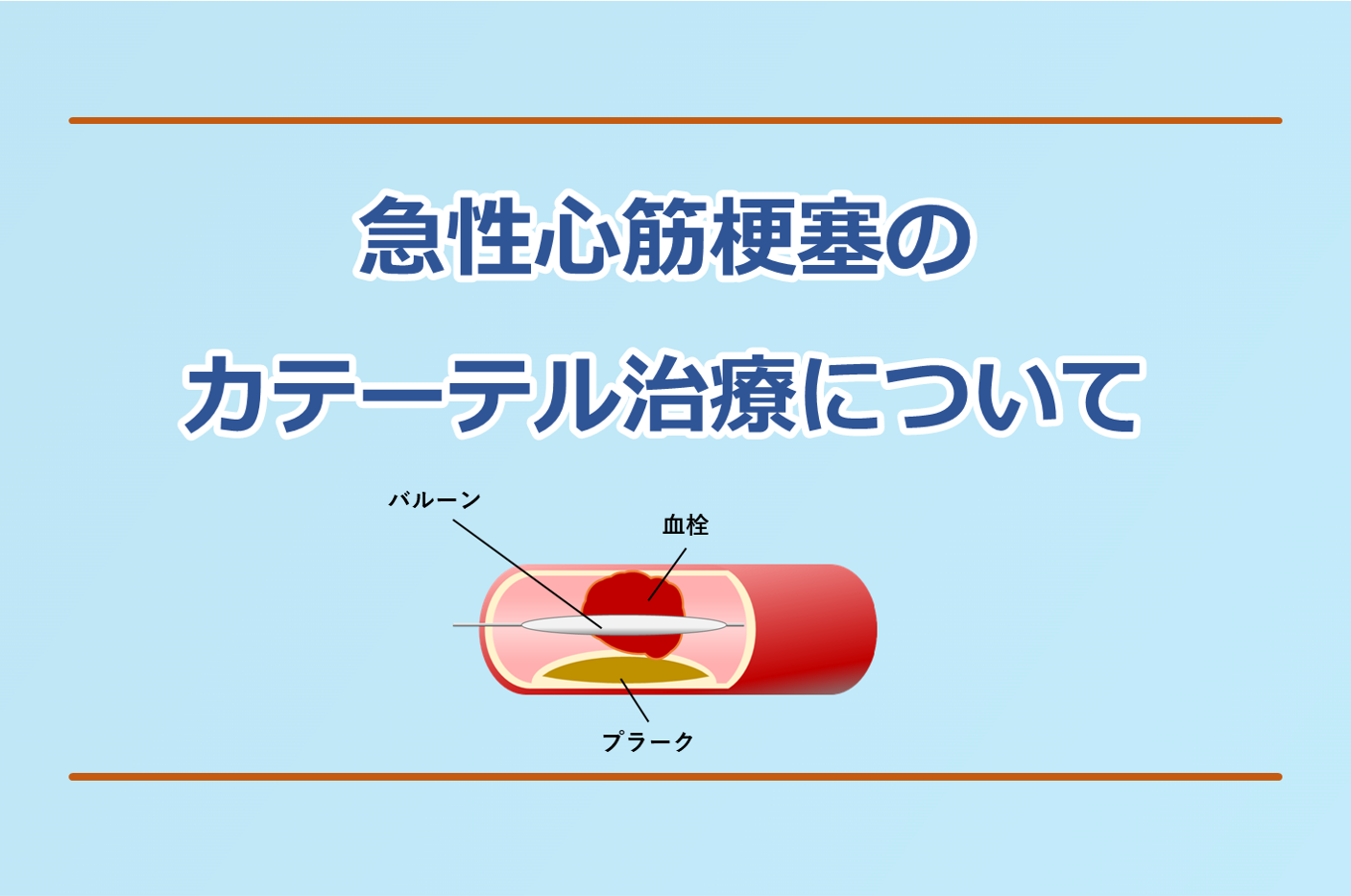 急性心筋梗塞のカテーテル治療を解説。バルーン拡張、ステント治療について。