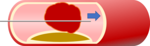 冠動脈のプラーク破裂にカテーテル治療を行うイラスト