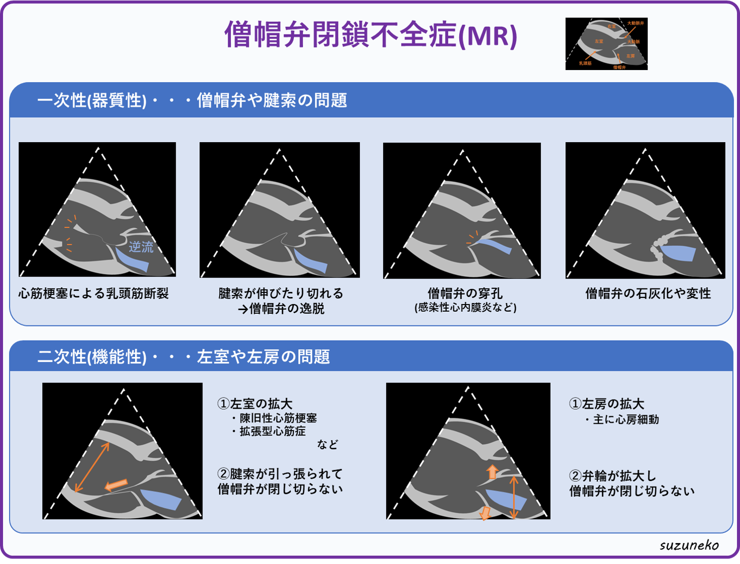 僧帽弁閉鎖不全症イラスト付きで解説。