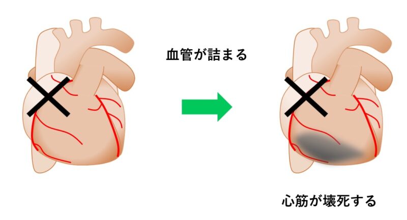 心筋梗塞のイメージ図